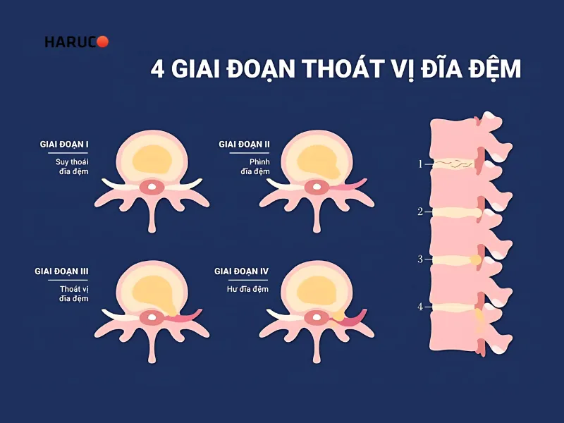 thoát vị đĩa đệm bao lâu thì khỏi - 2