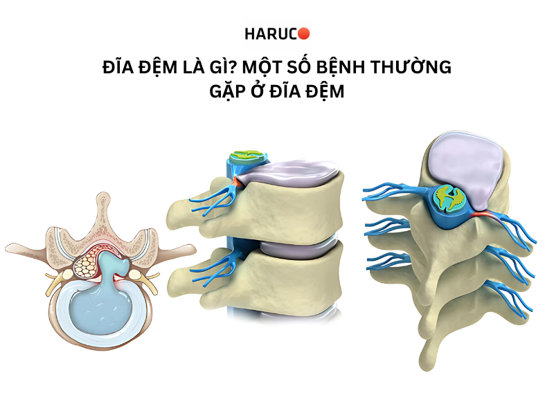 Đĩa đệm là gì? Một số bệnh thường gặp ở đĩa đệm