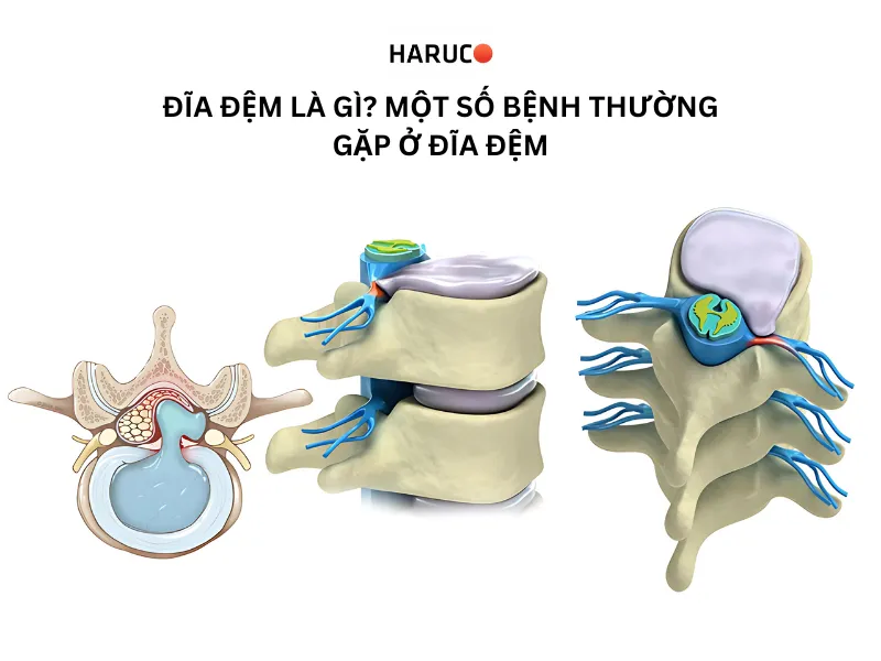  đĩa đệm là gì -1 