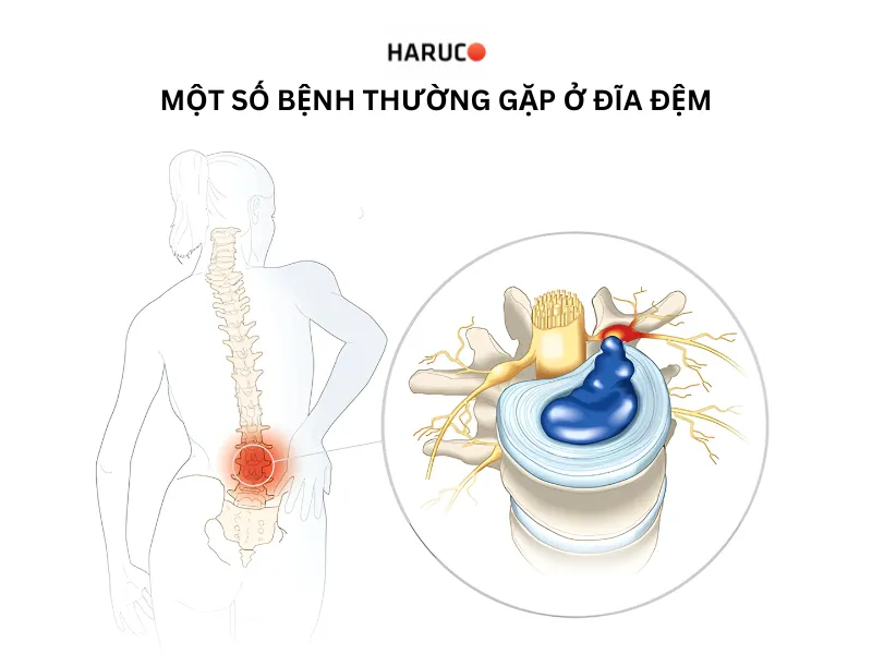 đĩa đệm là gì - 2