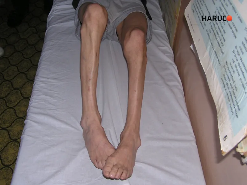 Bị thoát vị đĩa đệm có nguy hiểm không -3 