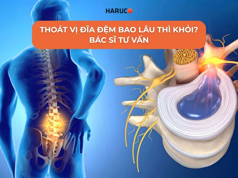 thoát vị đĩa đệm bao lâu thì khỏi
