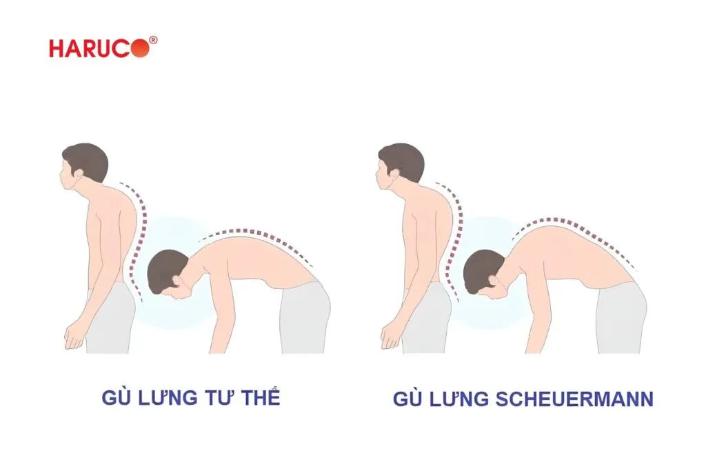 Dấu hiệu trẻ bị gù lưng thường xuất hiện âm thầm và dễ bị nhầm lẫn với tư thế xấu