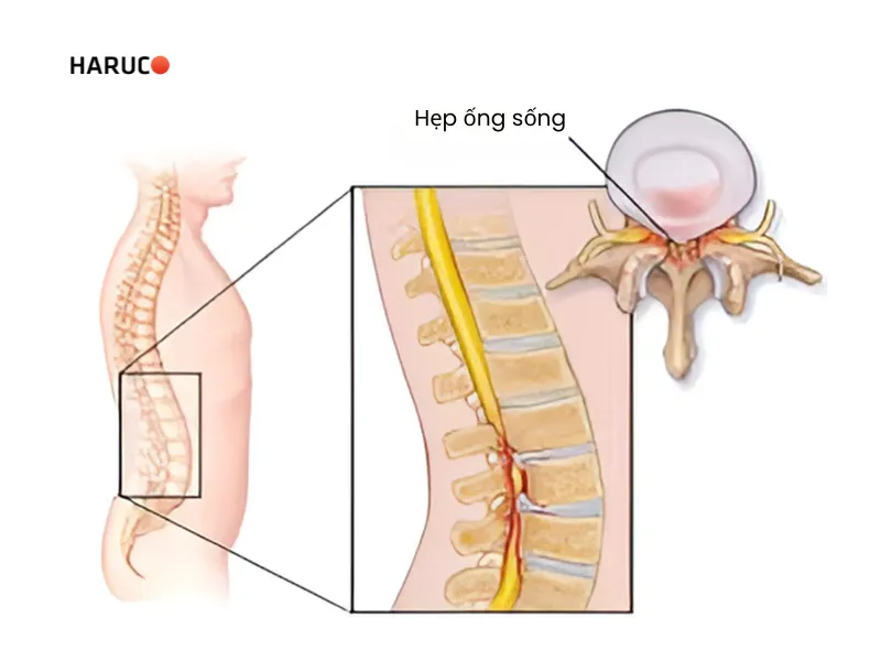 Hẹp ống sống thắt lưng có chữa được không - 1