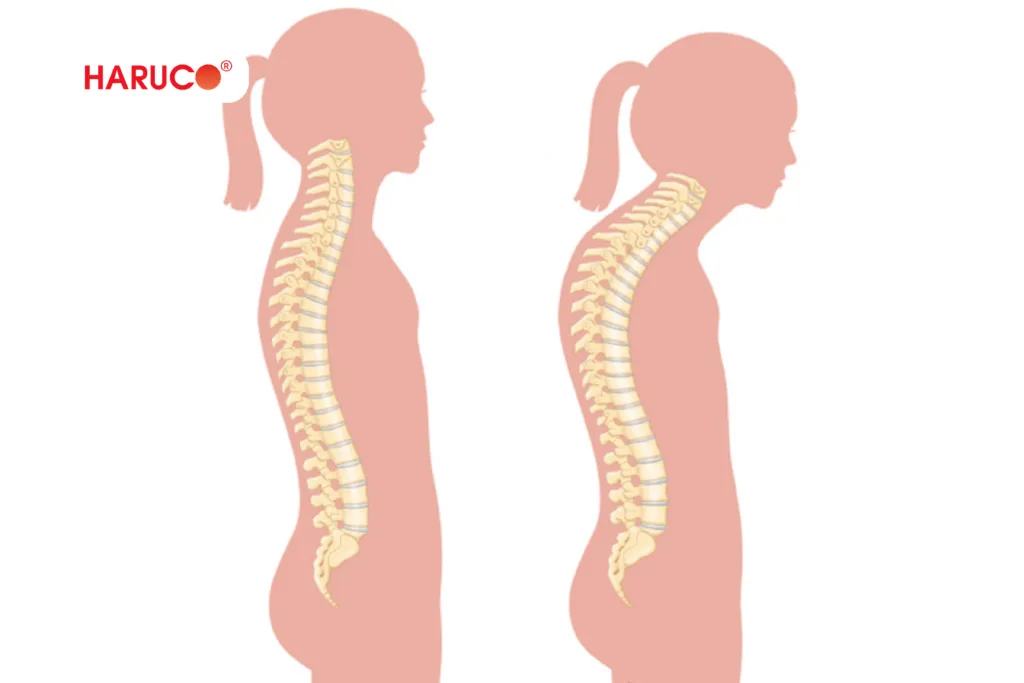 Bao lâu thì gù lưng bắt đầu cải thiện?