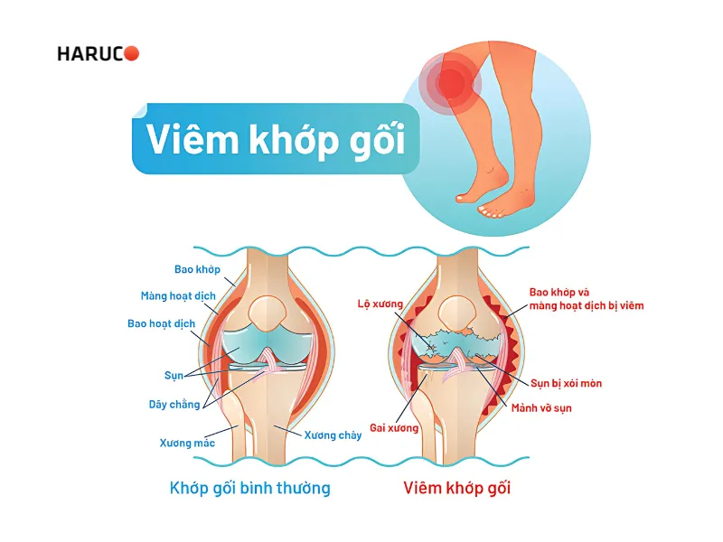 Viêm khớp gối -2