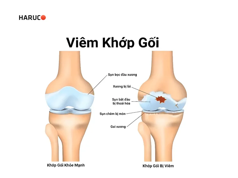viêm khớp gối ở trẻ em