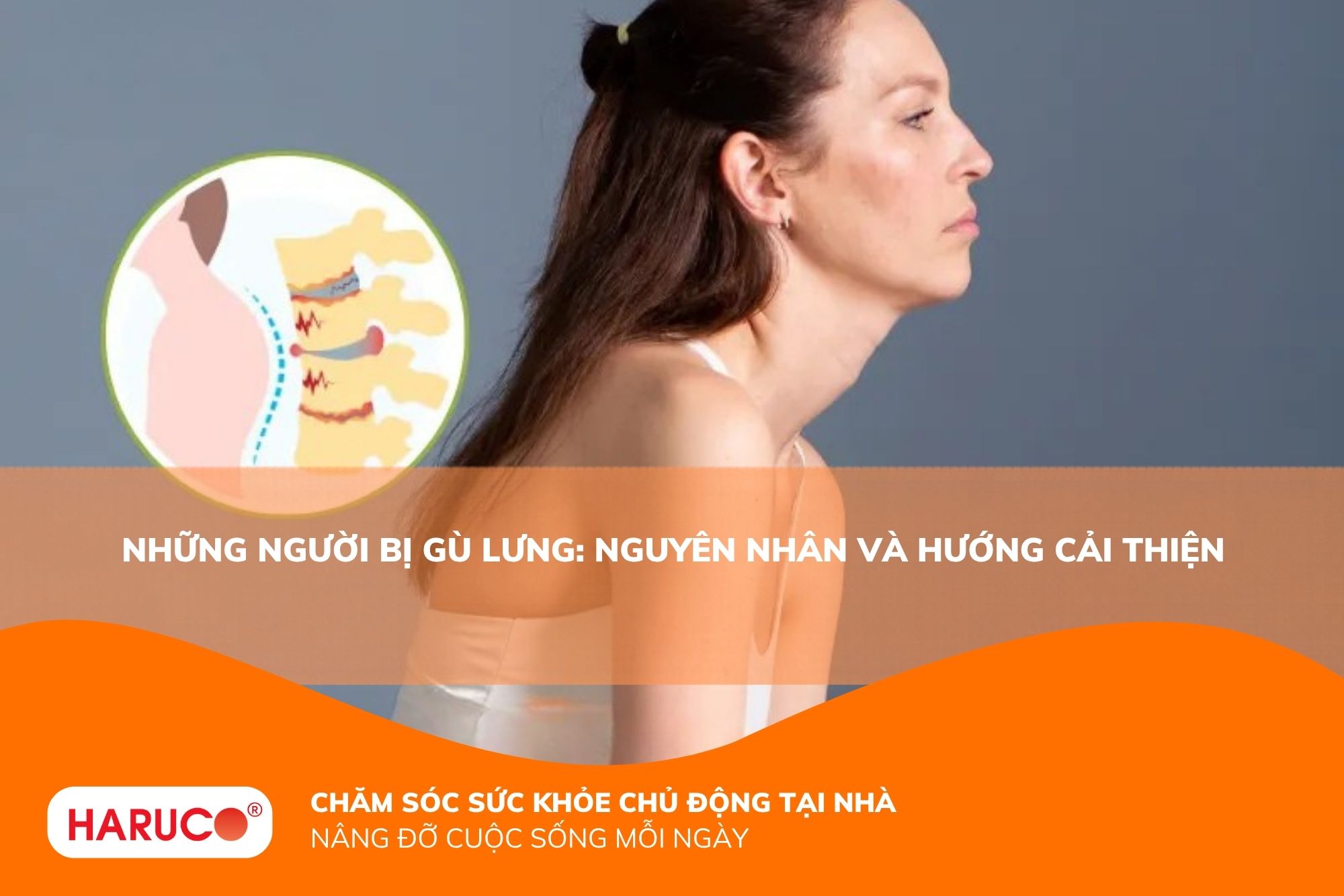 Những người bị gù lưng: Nguyên nhân và cách cải thiện