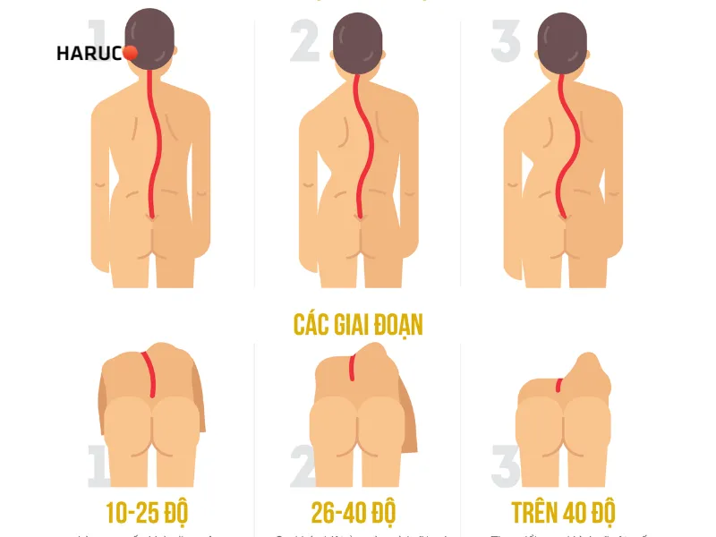 vẹo cột sống bao nhiêu độ là nặng