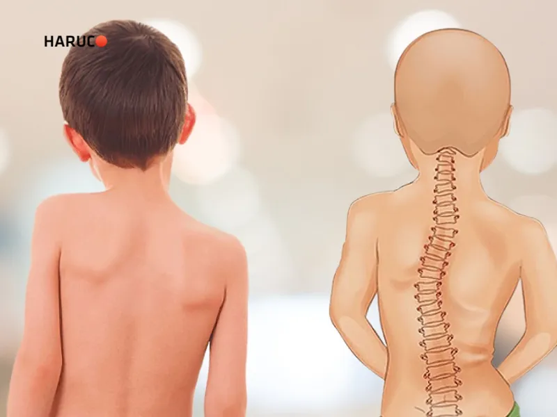 tác hại của tật cong vẹo cột sống
