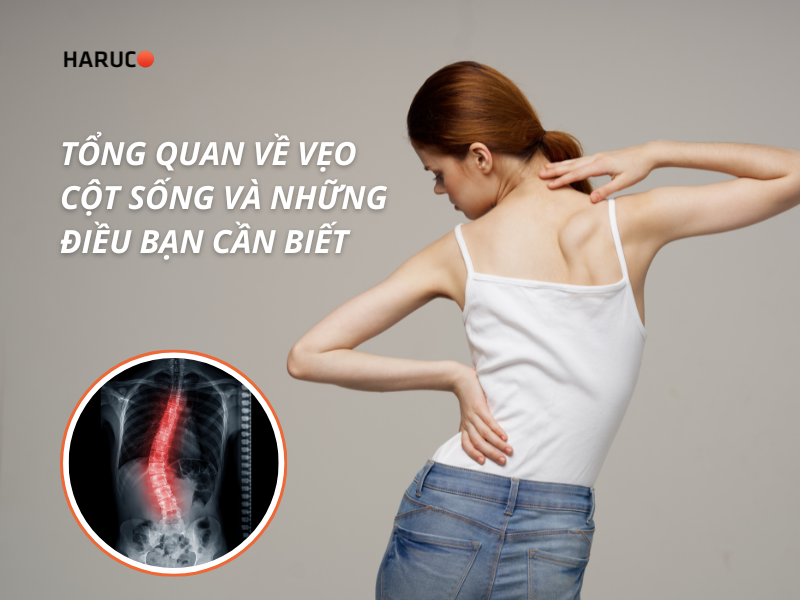 Tổng quan về vẹo cột sống và những điều bạn cần biết