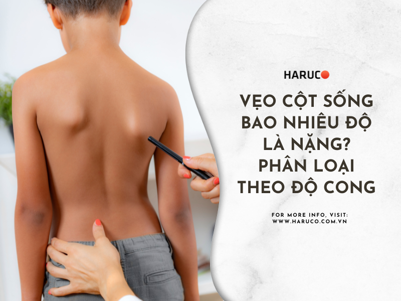 Vẹo cột sống bao nhiêu độ là nặng? Phân loại theo độ cong