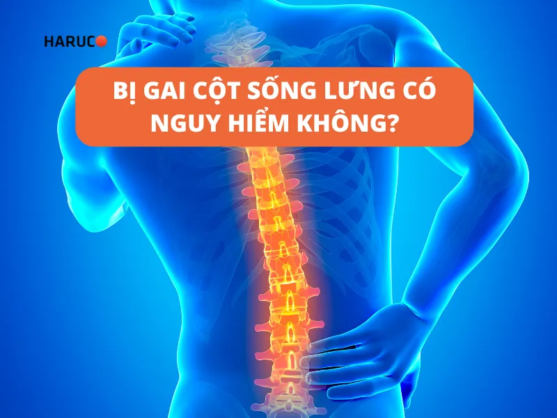 Bị gai cột sống lưng có nguy hiểm không