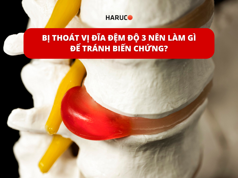 Bị thoát vị đĩa đệm độ 3 nên làm gì để tránh biến chứng?