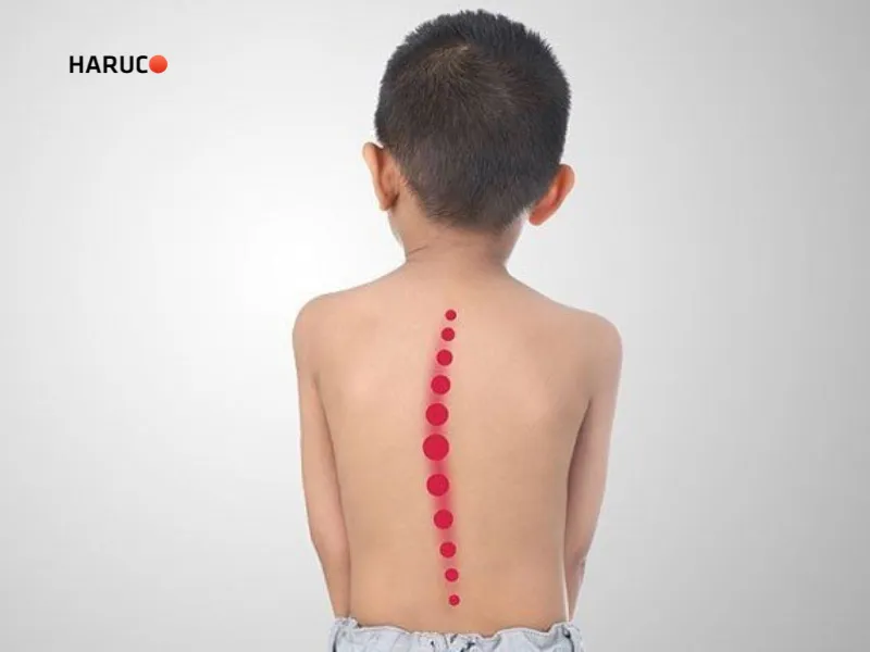 vẹo cột sống thắt lưng sang trái