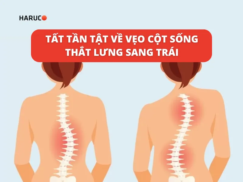 vẹo cột sống thắt lưng sang trái