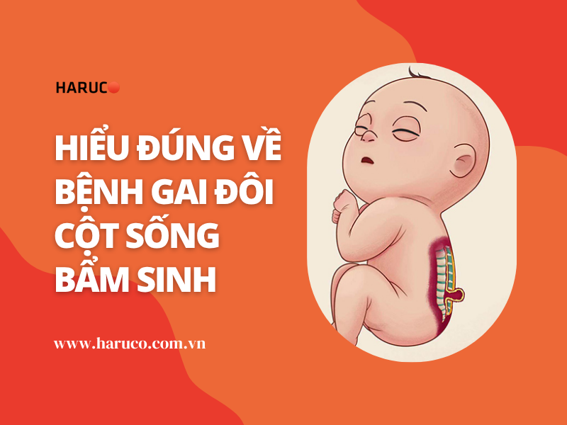 Hiểu đúng về bệnh gai đôi cột sống bẩm sinh