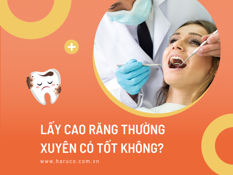 Lấy cao răng thường xuyên có tốt không?