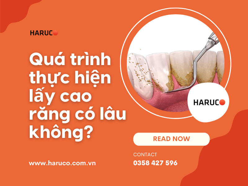 Quá trình thực hiện lấy cao răng có lâu không?