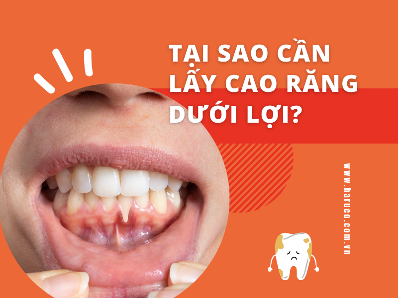 Tại sao cần lấy cao răng dưới lợi?