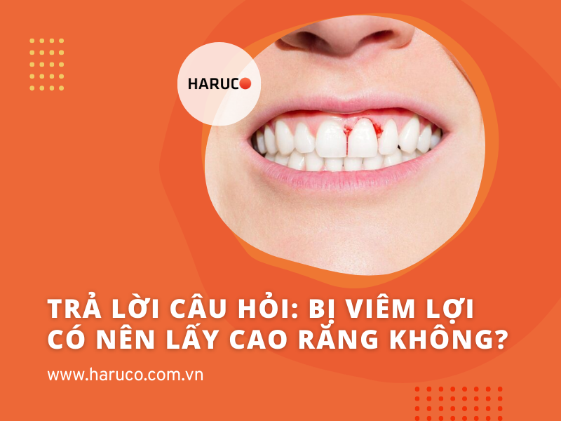 Trả lời câu hỏi: Bị viêm lợi có nên lấy cao răng không?