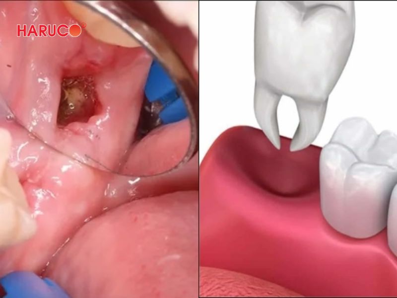 dai-gel-chuom-nong-lanh-haruco