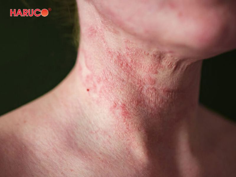 dai-gel-chuom-nong-lanh-haruco