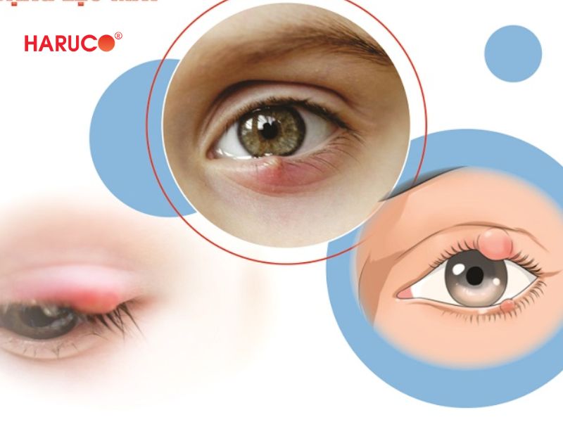 dai-gel-chuom-nong-lanh-haruco