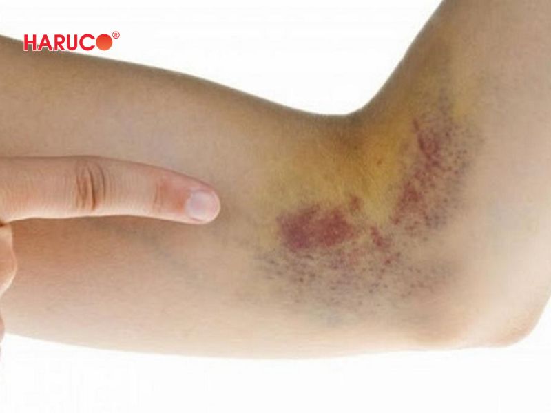 dai-gel-chuom-nong-lanh-haruco