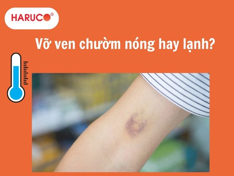 Vỡ ven chườm nóng hay lạnh? Cách xử lý đúng 