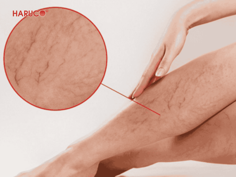 goi-ke-chan-gian-tinh-mach