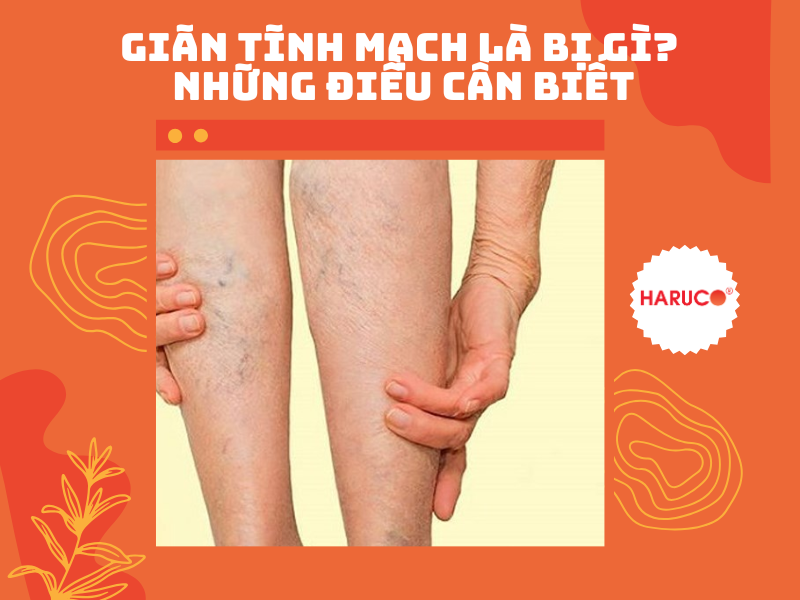 Giãn tĩnh mạch là bị gì? Những điều cần biết