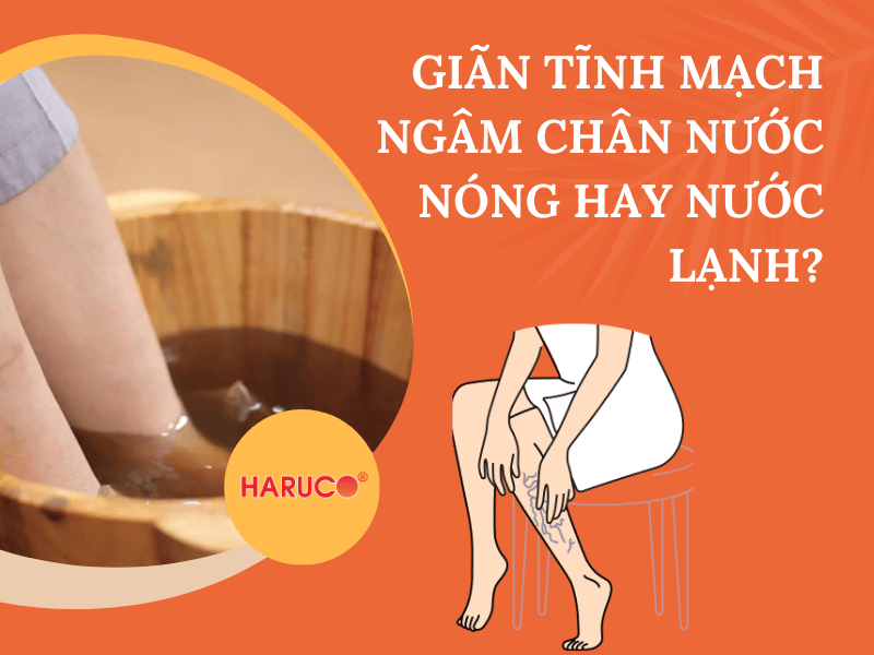 Giãn tĩnh mạch ngâm chân nước nóng hay nước lạnh?