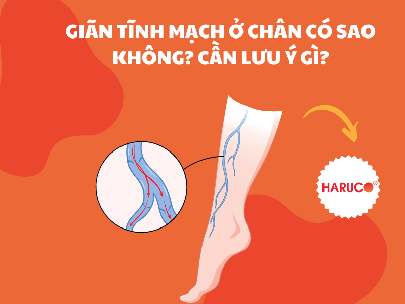 Giãn tĩnh mạch ở chân có sao không? Cần lưu ý gì?
