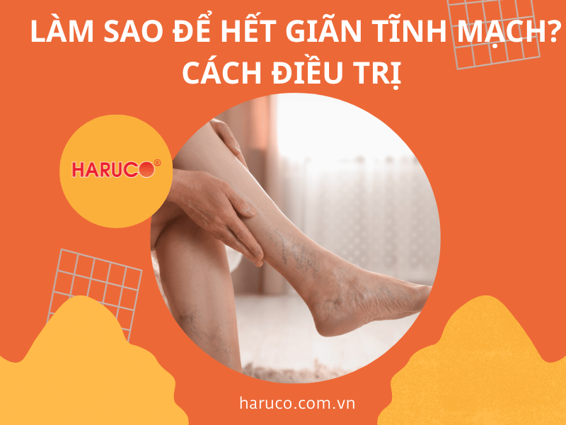 Làm sao để hết giãn tĩnh mạch? Cách điều trị
