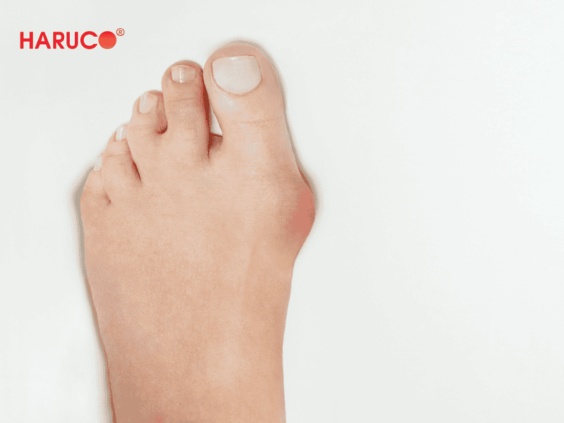 nep-chinh-hinh-ngon-chan-cai