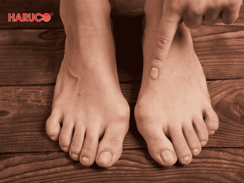 nep-chinh-hinh-ngon-chan-cai