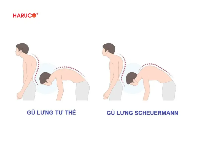 Gù lưng có nguy hiểm không - 2