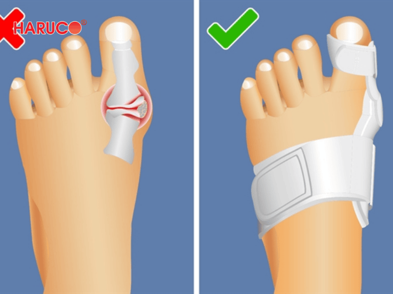 Nẹp chỉnh hình ngón chân cái