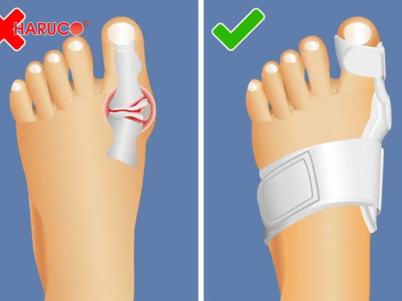 Nẹp chỉnh hình ngón chân cái