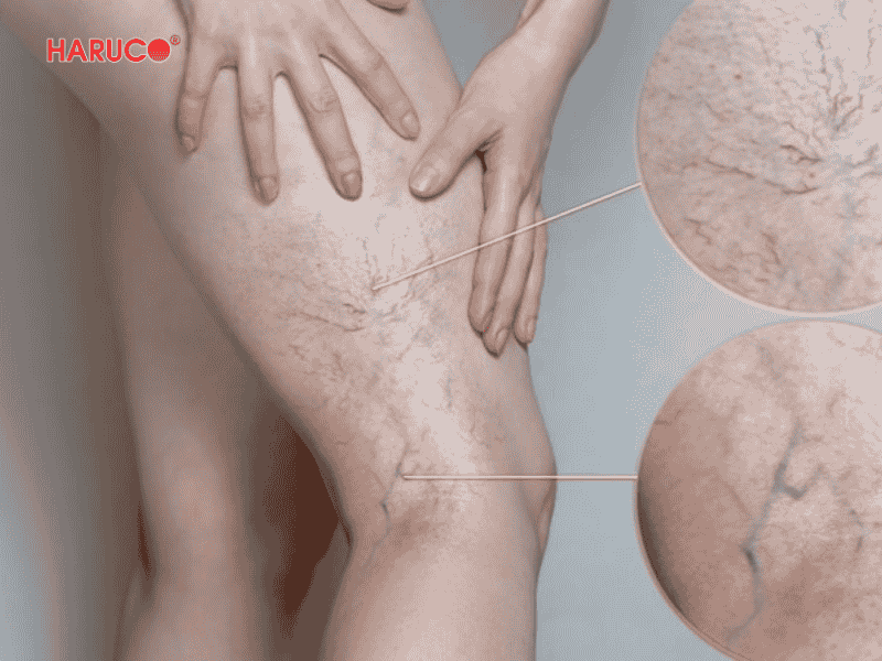 goi-ke-chan-gian-tinh-mach