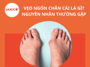 Nẹp chỉnh hình ngón chân cái