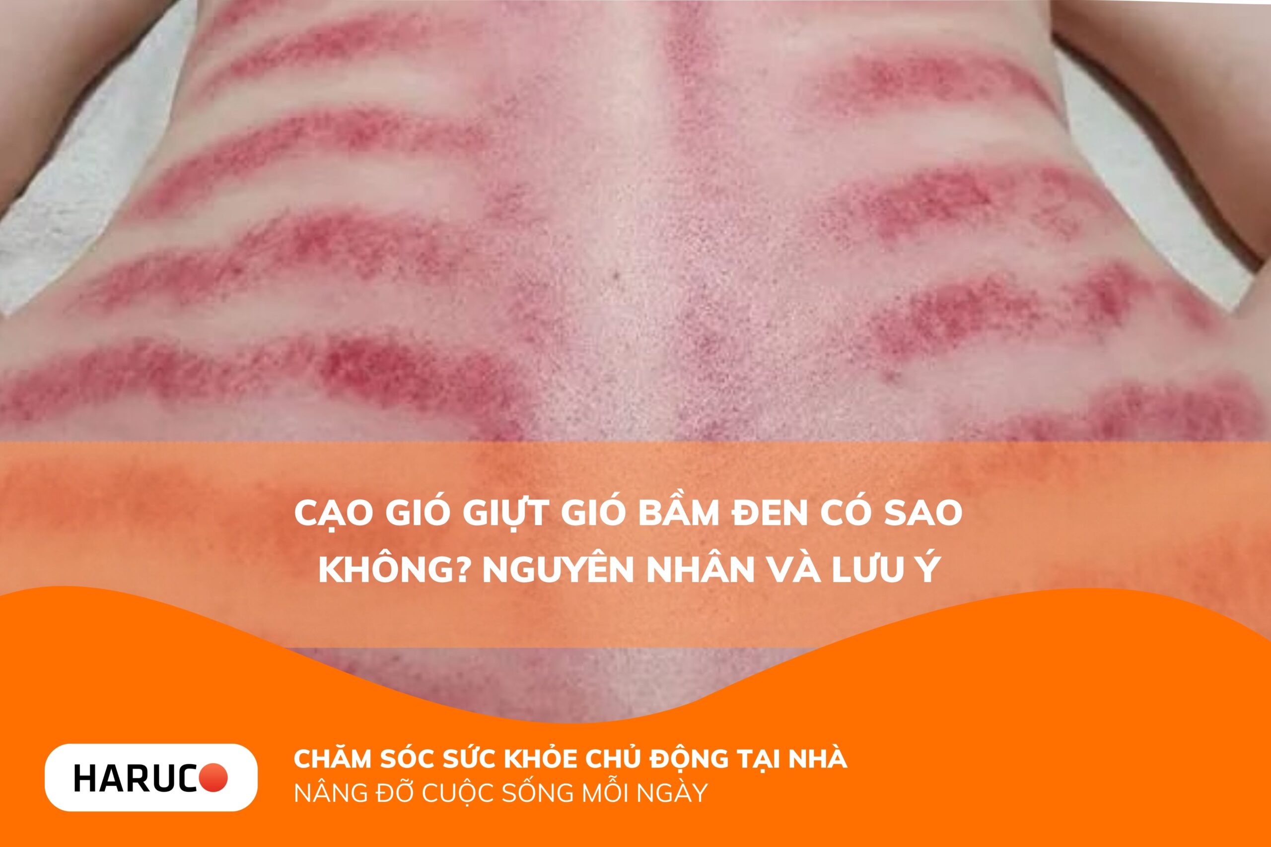 Cạo gió giựt gió bầm đen có sao không? Nguyên nhân và lưu ý