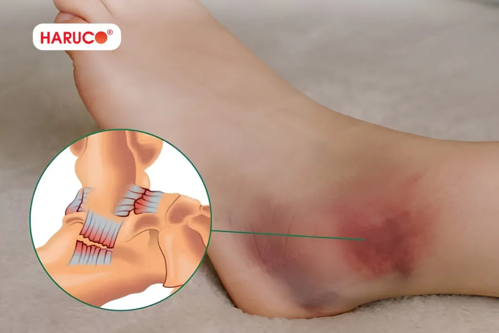 Những sai lầm khiến bong gân lâu khỏi mà nhiều người mắc phải