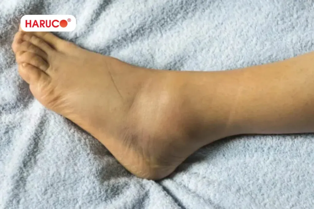 bong gân có nên đắp lá náng không, chỉ nên áp dụng sau khoảng 48 giờ kể từ khi bị bong gân, khi tình trạng sưng nóng đã giảm.