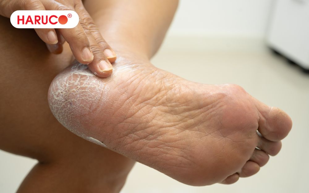 Nứt gót chân là hiện tượng lớp da ở vùng gót chân trở nên khô cứng, đau rát