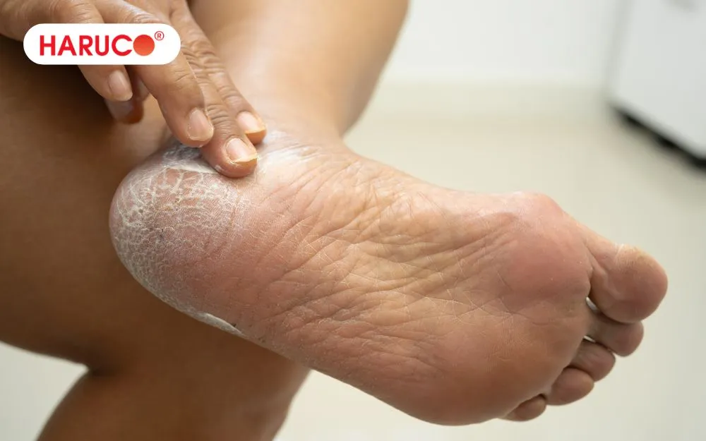 Nứt gót chân là hiện tượng lớp da ở vùng gót chân trở nên khô cứng, đau rát