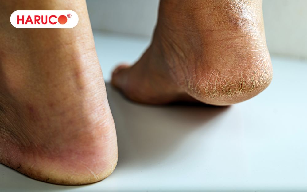 Các vết nứt quá sâu, hở miệng rộng nên khi khám bác sĩ