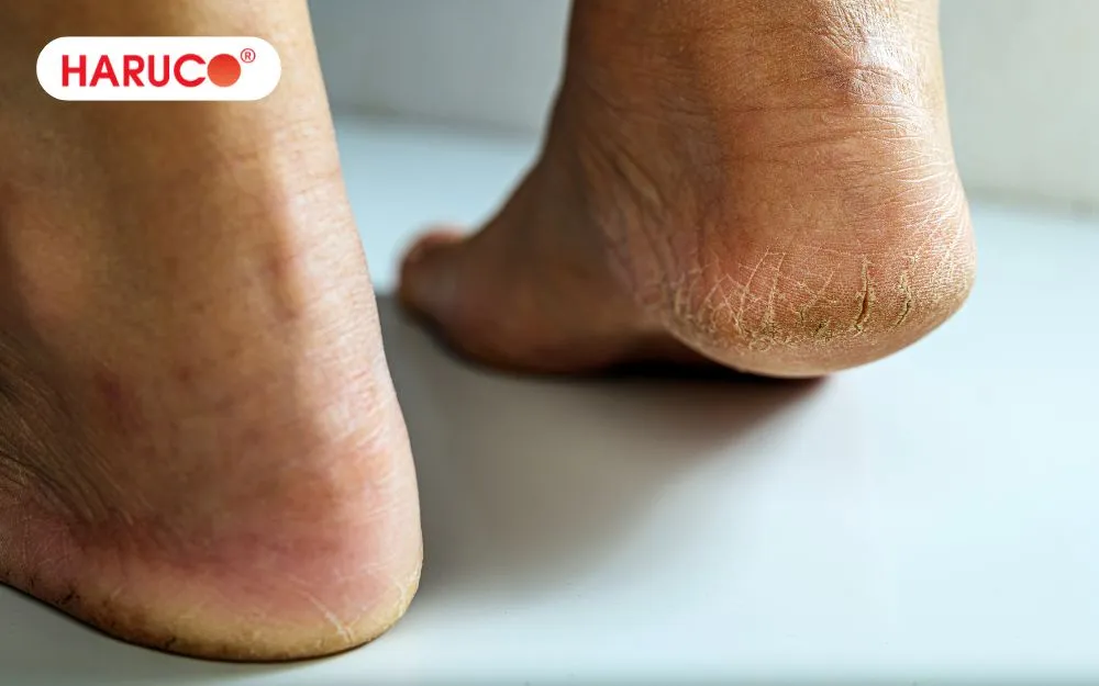 Các vết nứt quá sâu, hở miệng rộng nên khi khám bác sĩ