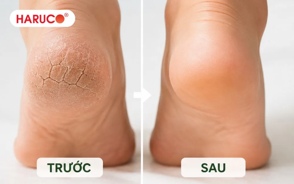Ngâm chân trị nứt gót chân đem tới hiệu quả rõ rệt